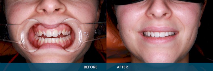 Take Porcelain Dental Veneers Services to Get a Dazzling Smile