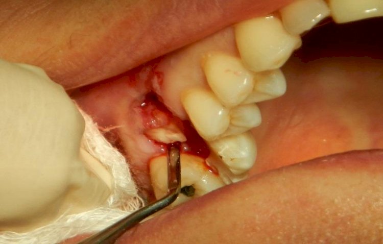 How To Prepare For Your Tooth Extraction?