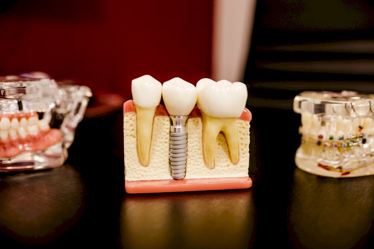 What to Know Before Getting Dental Implants