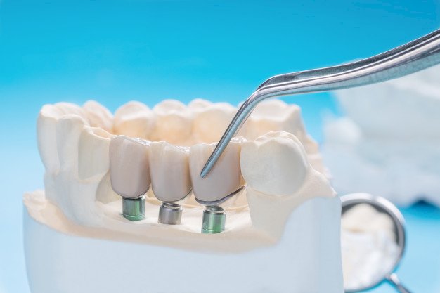 Vital Factors that Identify your Eligibility for Dental Implant